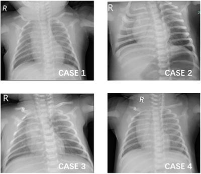 Case report: Acute hepatitis in neonates with COVID-19 during the Omicron SARS-CoV-2 variant wave: a report of four cases